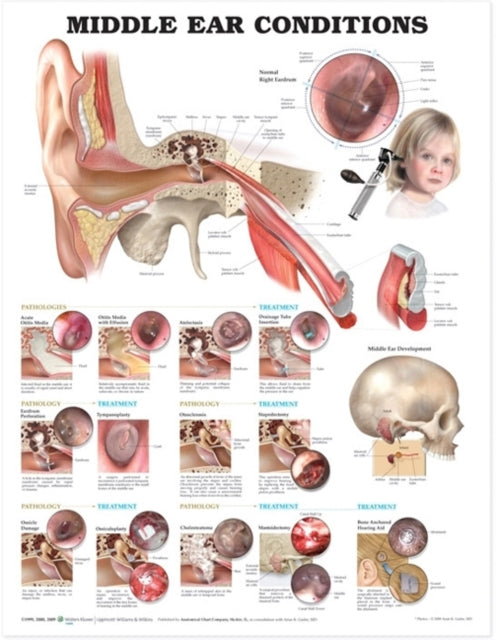 Book cover of: Middle Ear Conditions Anatomical Chart