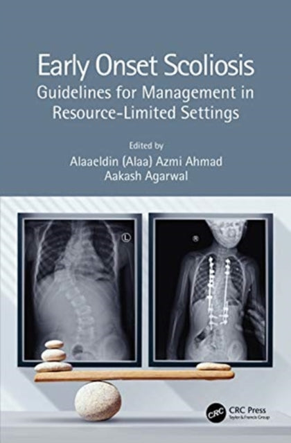 Book cover of: Early Onset Scoliosis. By: Alaaeldin Azmi Ahmad