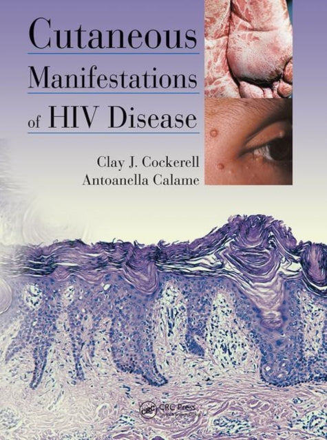 Book cover of: Cutaneous Manifestations of HIV Disease. By: Clay Cockerell