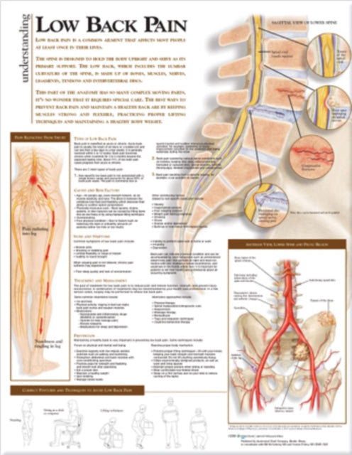 Book cover of: Understanding Low Back Pain Anatomical Chart