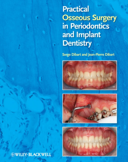Book cover of: Practical Osseous Surgery in Periodontics and Implant Dentistry. By: Serge Dibart