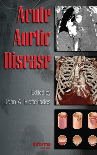 Book cover of: Acute Aortic Disease. By: John Elefteriades