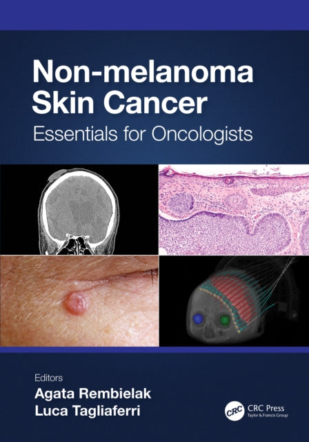 Book cover of: Non-melanoma Skin Cancer. By: Agata Rembielak