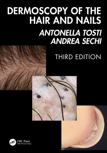 Book cover of: Dermoscopy of the Hair and Nails 3e. By: Antonella Tosti