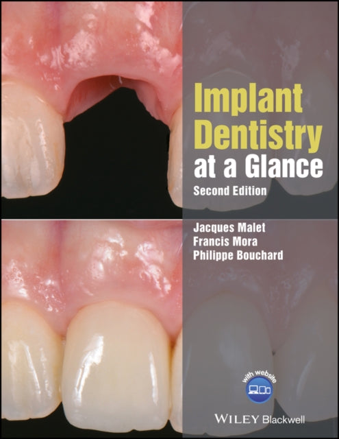 Book cover of: Implant Dentistry at a Glance. By: Jacques Malet