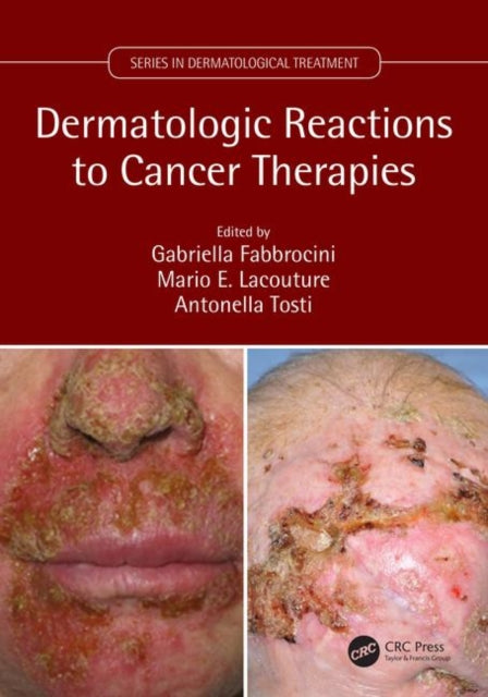 Book cover of: Dermatologic Reactions to Cancer Therapies. By: Gabriella Fabbrocini