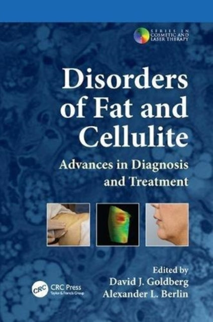 Book cover of: Disorders of Fat and Cellulite. By: David J. Goldberg