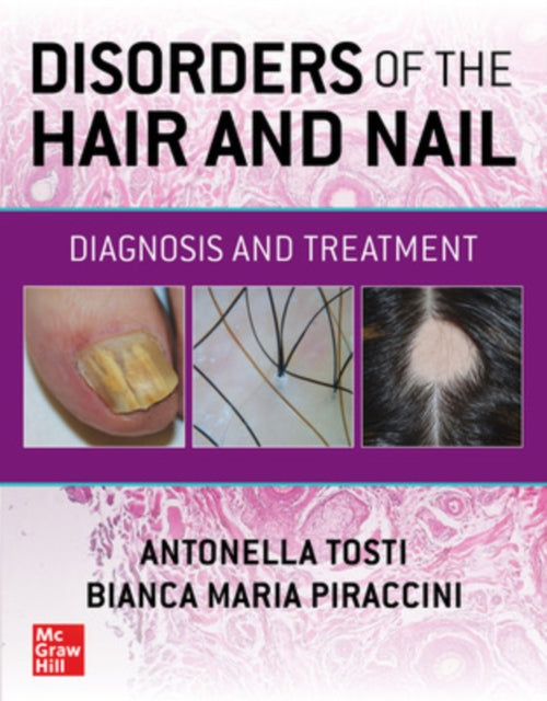 Book cover of: Disorders of the Hair and Nail: Diagnosis and Treatment. By: Antonella Tosti