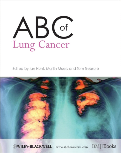 Book cover of: ABC of Lung Cancer. By: Ian Hunt