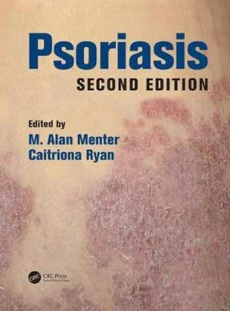 Book cover of: Psoriasis. By: Alan Menter
