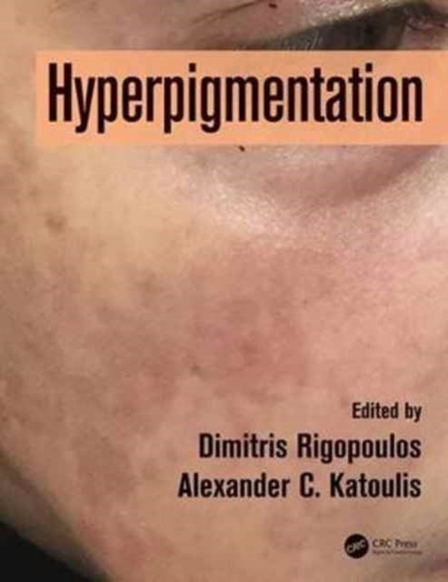 Book cover of: Hyperpigmentation. By: Dimitris Rigopoulos