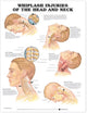 Book cover of: Whiplash Injuries of the Head and Neck Anatomical Chart. By: Anatomical Chart Company