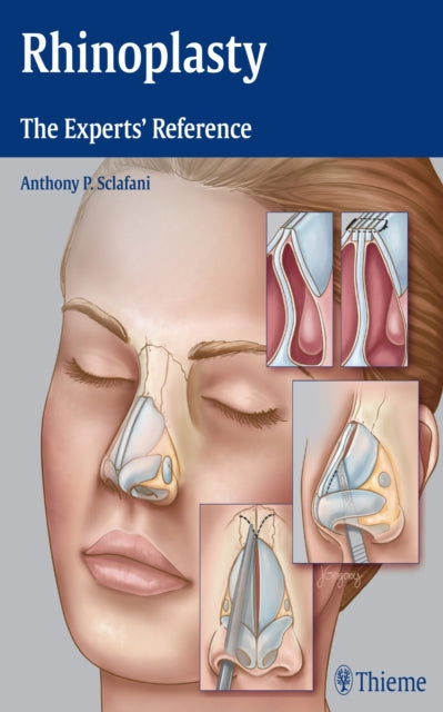 Book cover of: Rhinoplasty. By: Anthony P. Sclafani