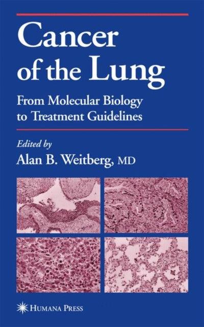 Book cover of: Cancer of the Lung. By: Alan B. Weitberg