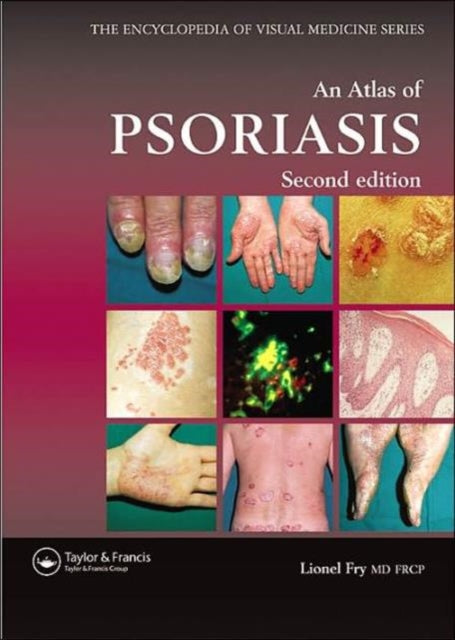 Book cover of: Atlas of Psoriasis, Second Edition. By: Lionel Fry