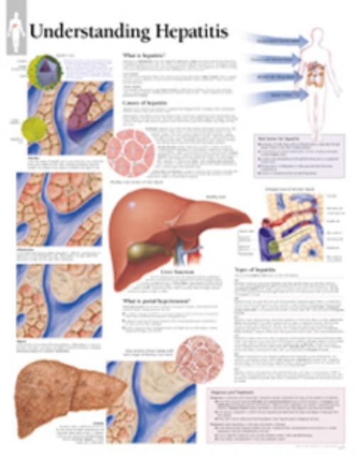 Book cover of: Understanding Hepatitis Laminated Poster