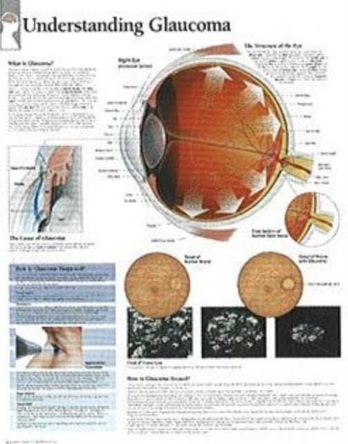 Book cover of: Understanding Glaucoma Paper Poster