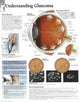 Book cover of: Understanding Glaucoma Paper Poster