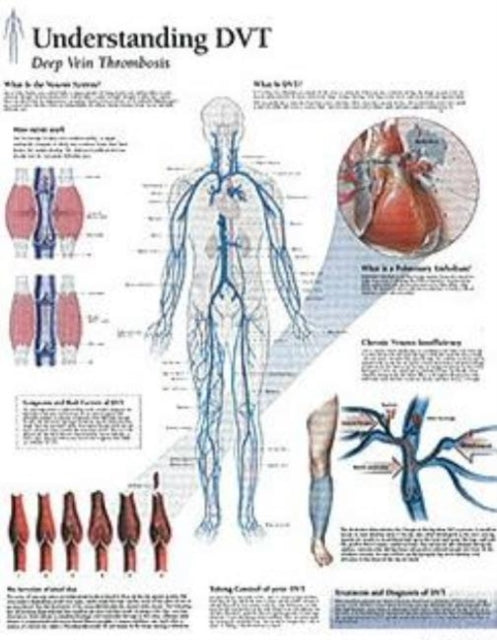 Book cover of: Understanding DVT Laminated Poster