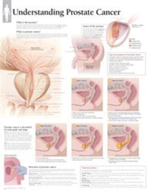 Book cover of: Understanding Prostate Cancer Laminated Poster