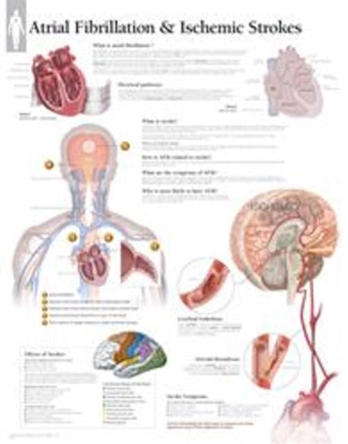 Book cover of: Atrial Fib & Ischemic Strokes Laminated Poster