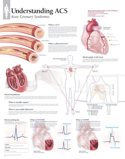 Book cover of: Understanding ACS (Acute Coronary Syndrome) Paper Poster
