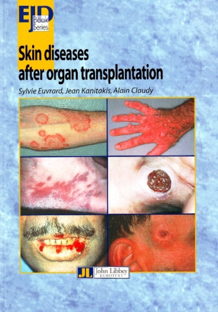 Book cover of: Skin Diseases After Organ Transplantation