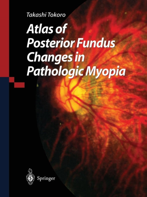 Book cover of: Atlas of Posterior Fundus Changes in Pathologic Myopia. By: Takashi Tokoro
