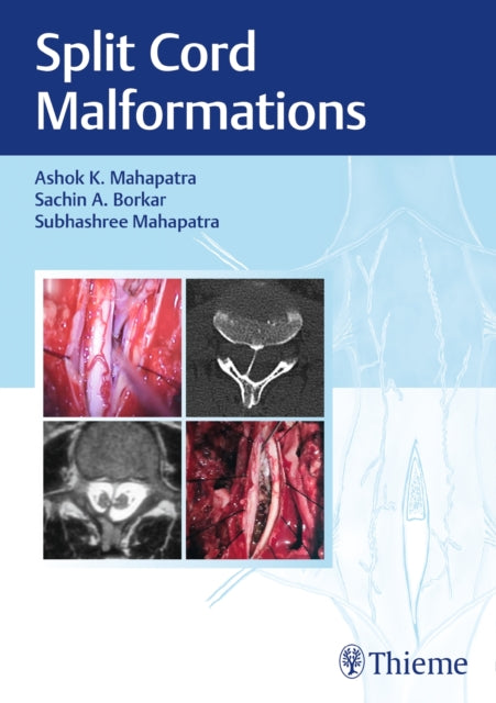Book cover of: Split Cord Malformations. By: Mahapatra