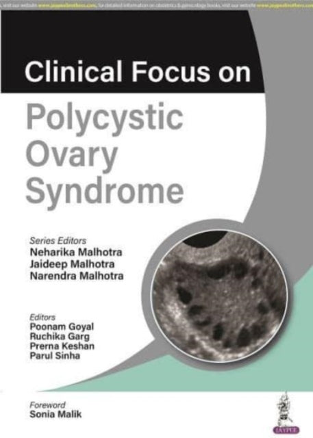 Book cover of: Clinical Focus on Polycystic Ovary Syndrome. By: Malhotra MALHOTRA