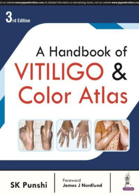 Book cover of: Handbook of Vitiligo & Color Atlas. By: S. K. Punshi